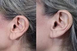 Earlobe Correction Surgery Abu Dhabi