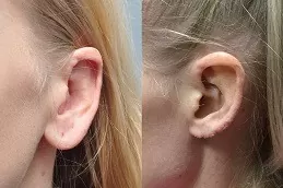 Earlobe Correction Surgery Clinic in Dubai