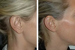 Earlobe Correction Surgery Dubai