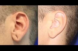 Earlobe Correction Surgery in Abu Dhabi
