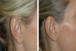 Earlobe Correction Surgery in Dubai