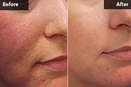 Enlighten Pico Genesis Clinic in Dubai