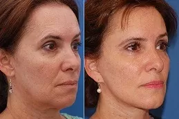 Facelift in Dubai