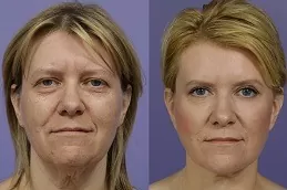 Facelift surgery Dubai