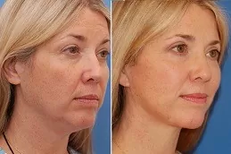 Facelift surgery