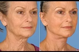 Facelift in Dubai