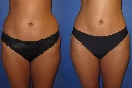 Fat Transfer Surgery Clinic Abu Dhabi