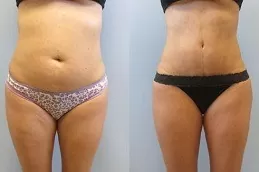 Fat Transfer Surgery Clinic in Dubai