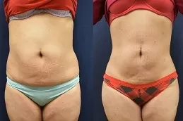Fat Transfer Surgery Dubai & Abu Dhabi