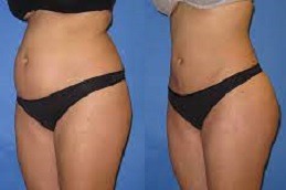 Fat Transfer Surgery Dubai & Abu Dhabi