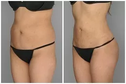 Fat Transfer Surgery in Abu Dhabi