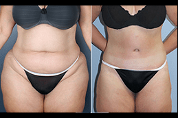 Fat Transfer Surgery in Dubai