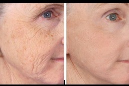 Fine Lines and Wrinkles treatment in Dubai