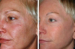 Fine Lines and Wrinkles treatment Dubai