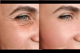 Wrinkles treatment