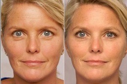 Fine Lines and Wrinkles treatment