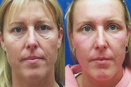 Wrinkles treatment in Dubai