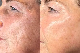 Wrinkles treatment Dubai