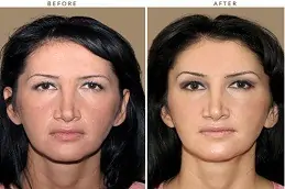 Forehead Lift Abu Dhabi & Dubai