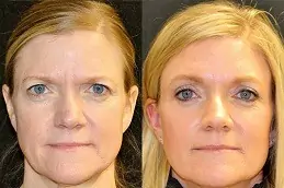 Forehead Lift Clinic in Dubai