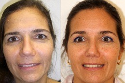 Forehead Lift Dubai & Abu Dhabi