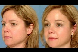 Forehead Lift in Abu Dhabi