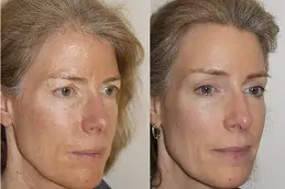 Forehead Lift in Dubai & Abu Dhabi