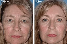 Forehead Lift in Dubai