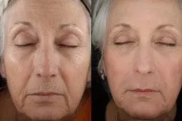 Before & After CO2 Fractional Laser Treatment in Dubai
