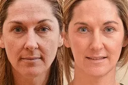 Before & After CO2 Fractional Laser Treatment Dubai