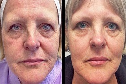 CO2 Fractional Laser Treatment Dubai Before & After 