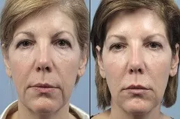 CO2 Fractional Laser Treatment Before & After
