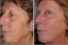 Before & After CO2 Fractional Laser Treatment