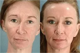 CO2 Fractional Laser Treatment in Dubai Before & After 