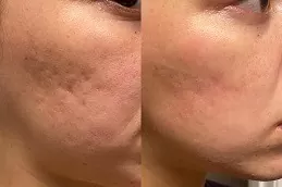 Fractional RF Microneedling Dubai & Abu Dhabi