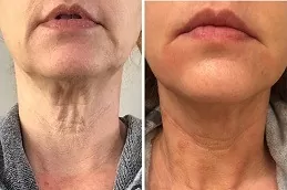 Fractional RF Microneedling in Abu Dhabi