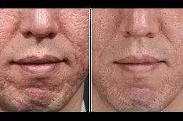 Fractional RF Microneedling in Dubai Abu Dhabi