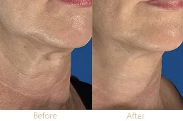 Fractional RF Microneedling in Dubai