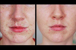 Freckles and Blemishes Abu Dhabi