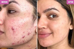 Freckles and Blemishes Clinic in Abu Dhabi