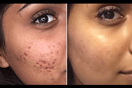 Freckles and Blemishes Clinic in Dubai