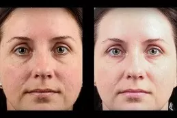 Freckles and Blemishes Dubai & Abu Dhabi