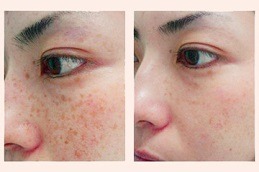 Freckles and Blemishes Dubai