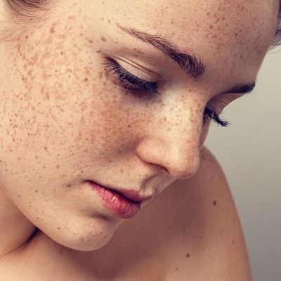 Freckles and Blemishes Treatment in Dubai, Abu Dhabi & Sharjah Cost