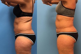GPS Laser Liposuction Clinic Abu Dhabi