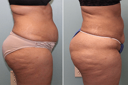 GPS Laser Liposuction Clinic Dubai