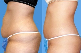 GPS Laser Liposuction Dubai