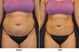 GPS Laser Liposuction in Abu Dhabi