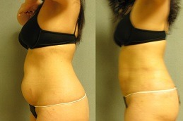 GPS Laser Liposuction in Dubai