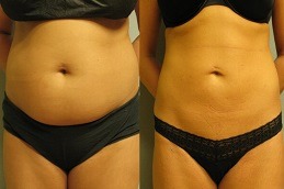 GPS Laser Liposuction